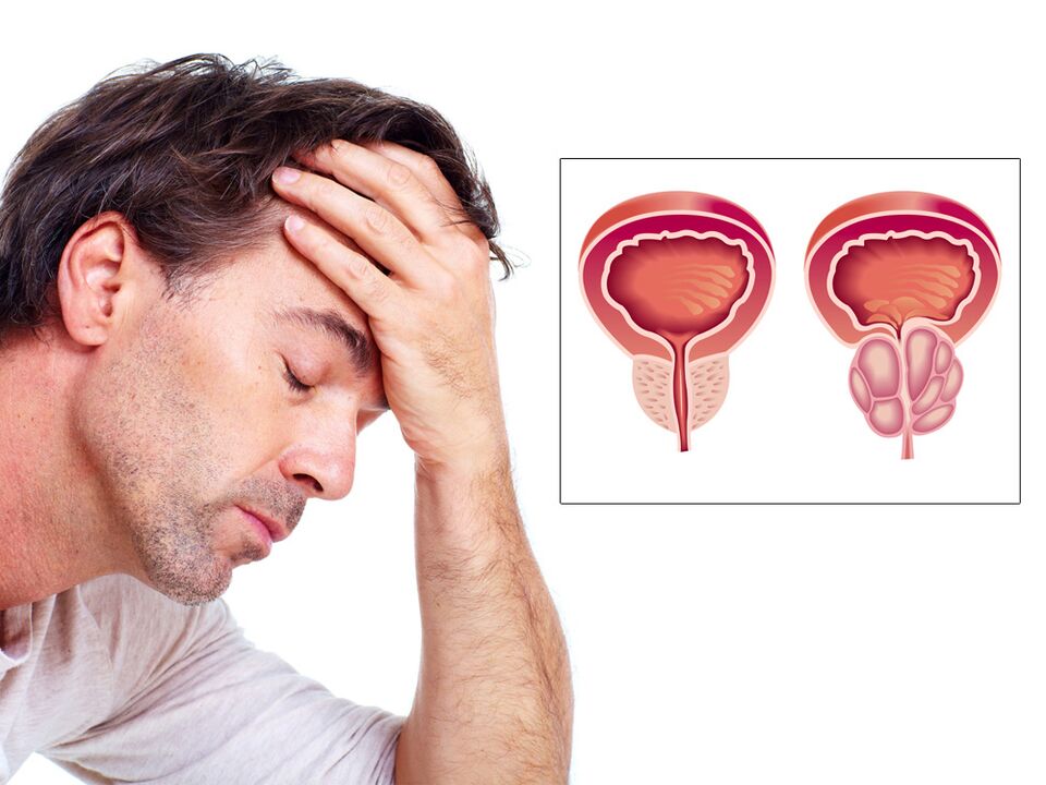 Adénome de la prostate avec impuissance